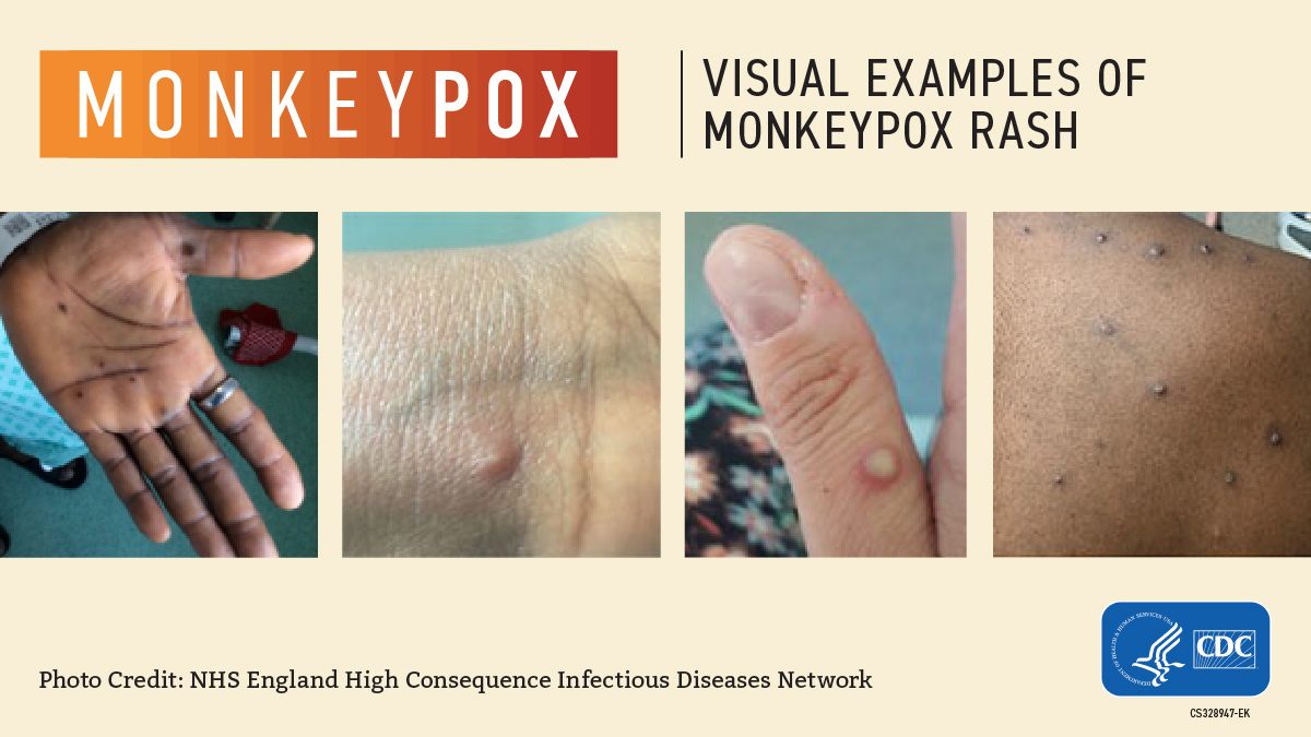 Monkeypox rash example